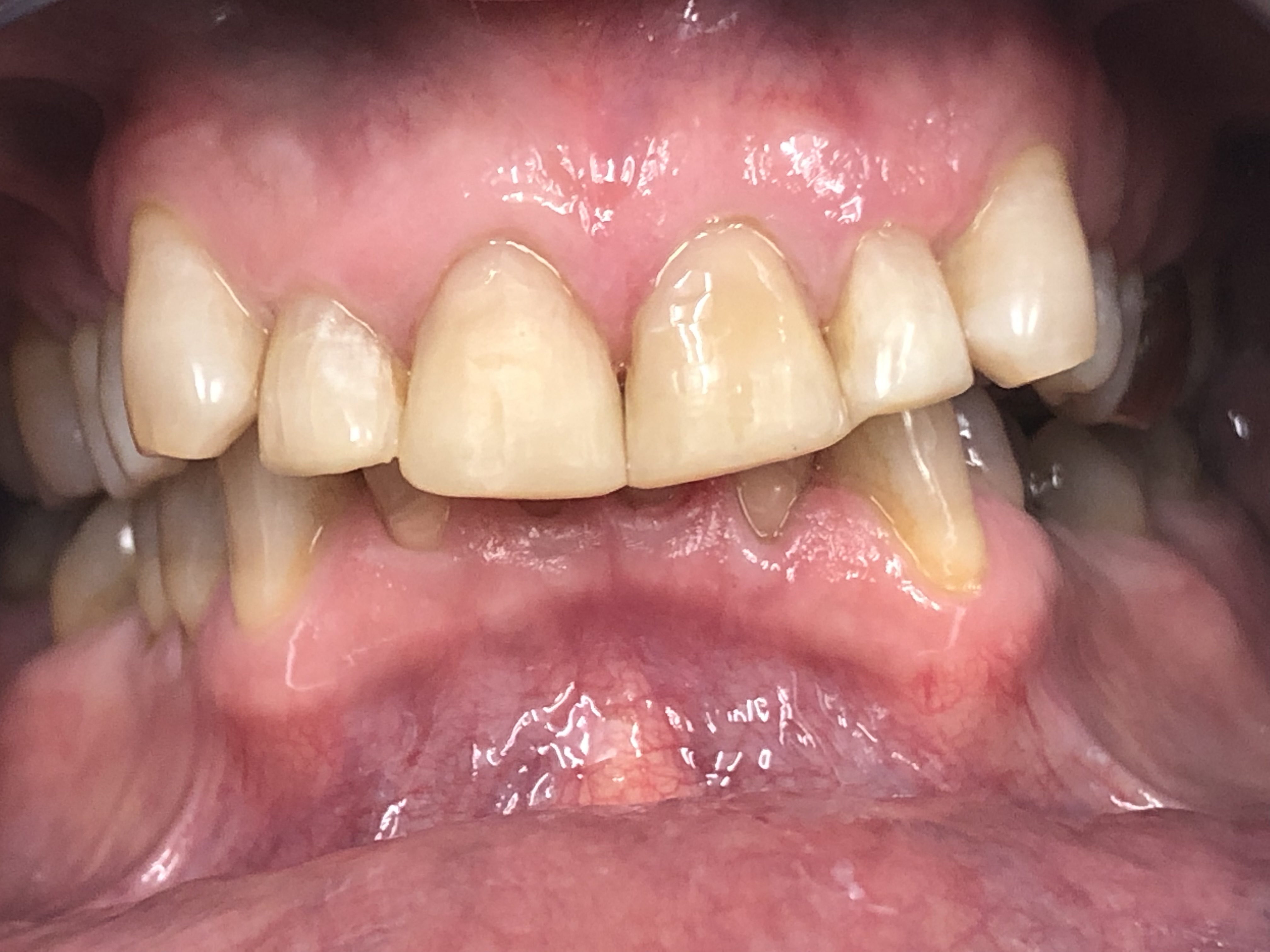 After composite bonding